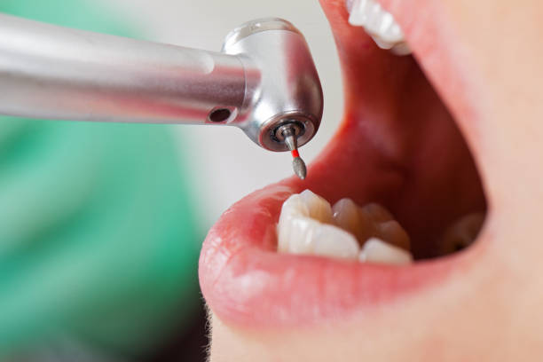 Best Knocked-Out Tooth (Avulsed Tooth) Treatment in Freeport, PA